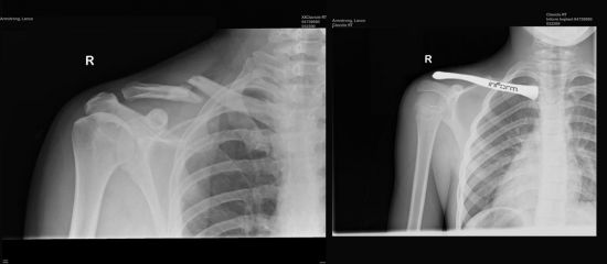 lance_armstrong_carbon_clavicle_collar-bone-xray_1